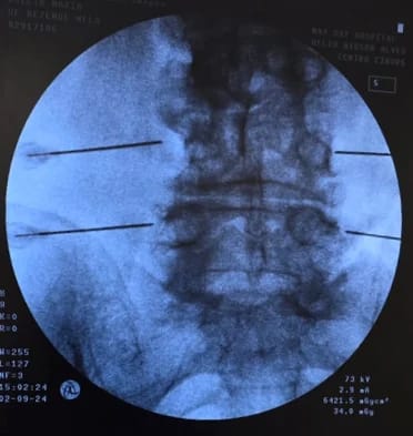 Radiofrequency