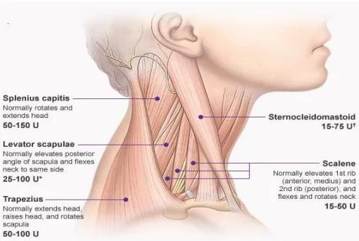 Botulinum Toxin for Dystonia and Spasticity