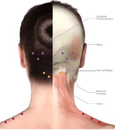 Botulinum Toxin for Chronic Migraine